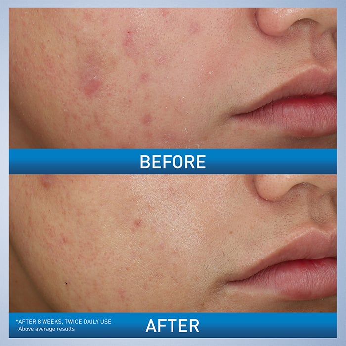 benzoyl-peroxide-face-wash